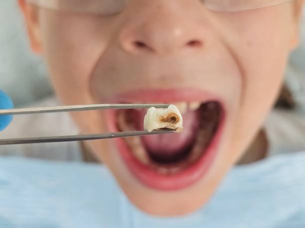 Best Broken Tooth Emergency  in Cotati, CA